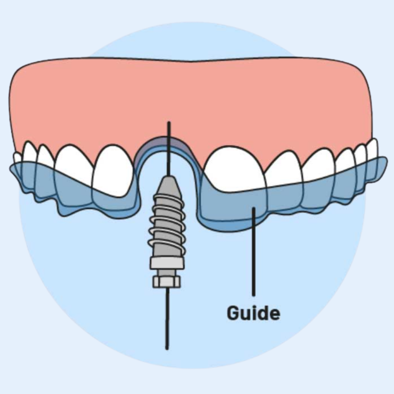 guided implant 2